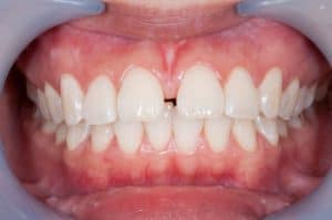 Teeth straightening treatments Sylvania