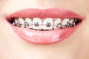 metal braces for straight teeth Sylvania