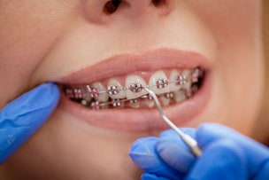 Different types of braces for straight teeth Sylvania